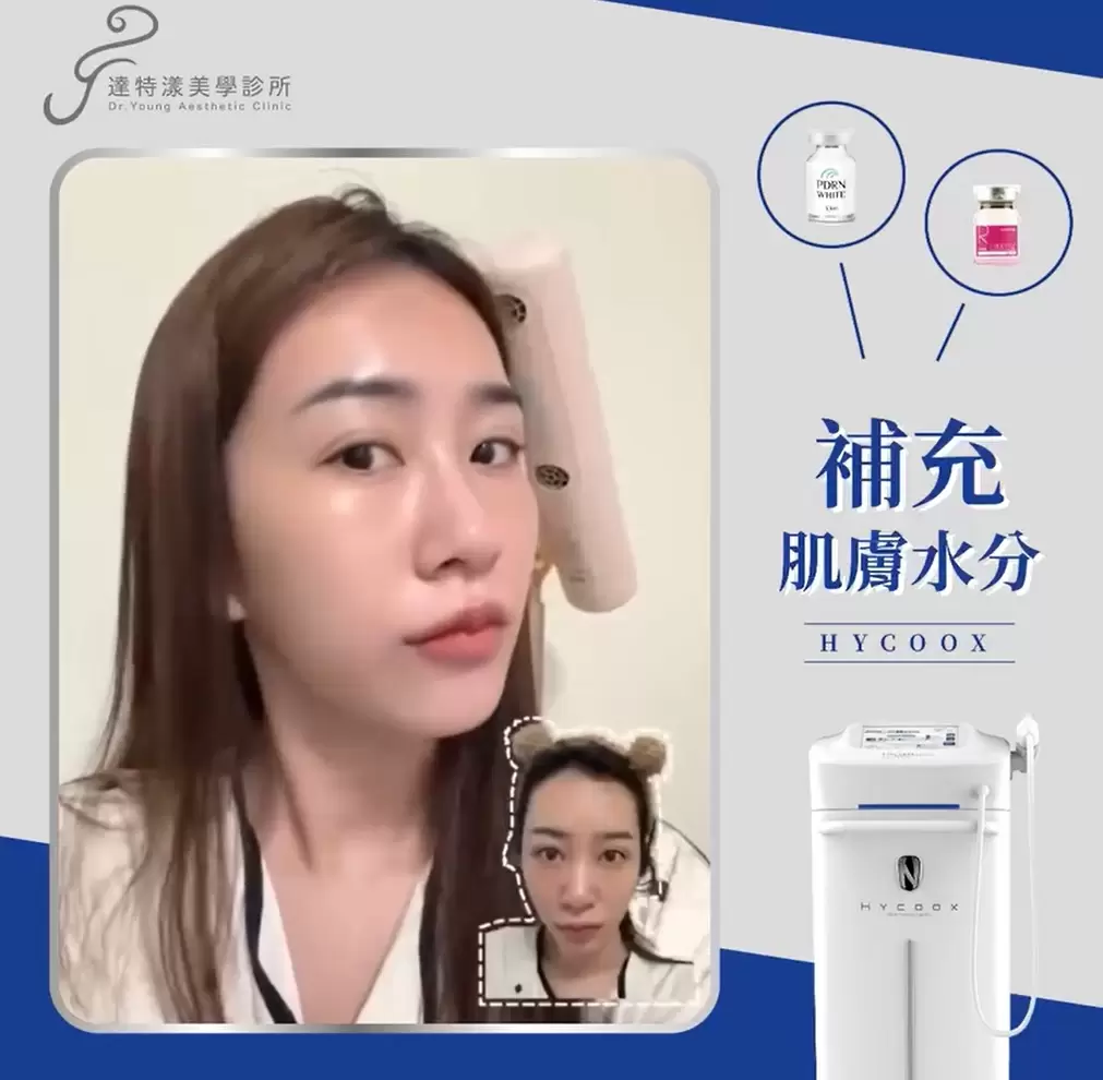  想讓肌膚長時間水嫩透亮？「水光注射」就是你的秘密武器