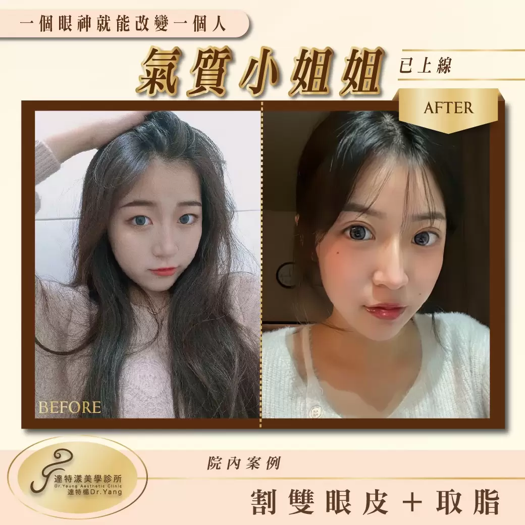  高雄整形外科 客製化雙眼皮＋取脂療程院內案例