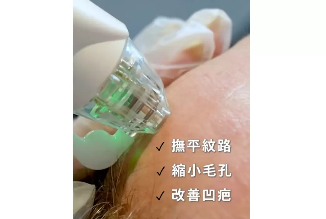 雷神微針電波 撫平紋路 縮小毛孔 改善凹疤 由內而外找回你的緊緻完美肌