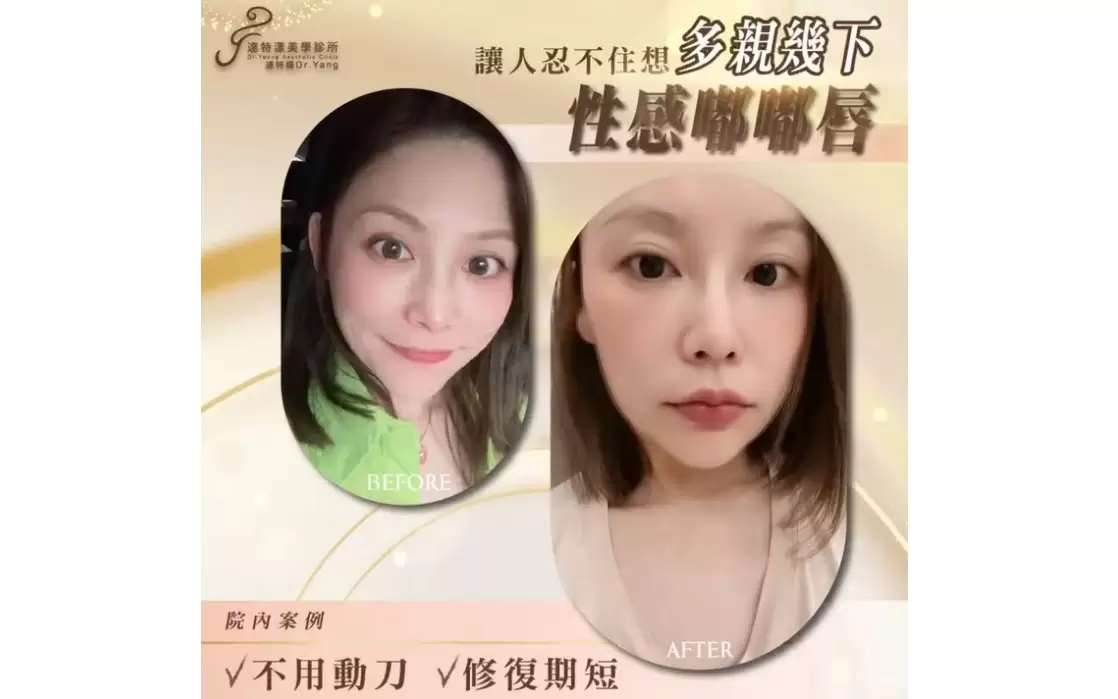 豐潤自然的微笑嘟嘟唇看起來減齡不少呢 玻尿酸豐唇院內案例