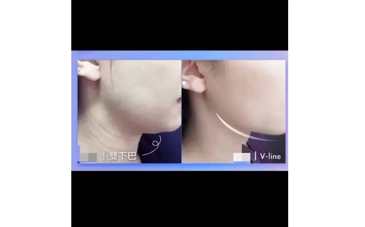 昂達ONDA超微波將肉肉臉推回骨架邊界 輪廓線條貼骨立現