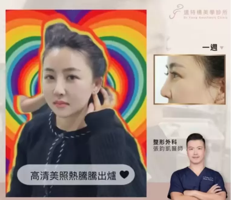 鼻部整形/隆鼻重建/鼻形雕塑