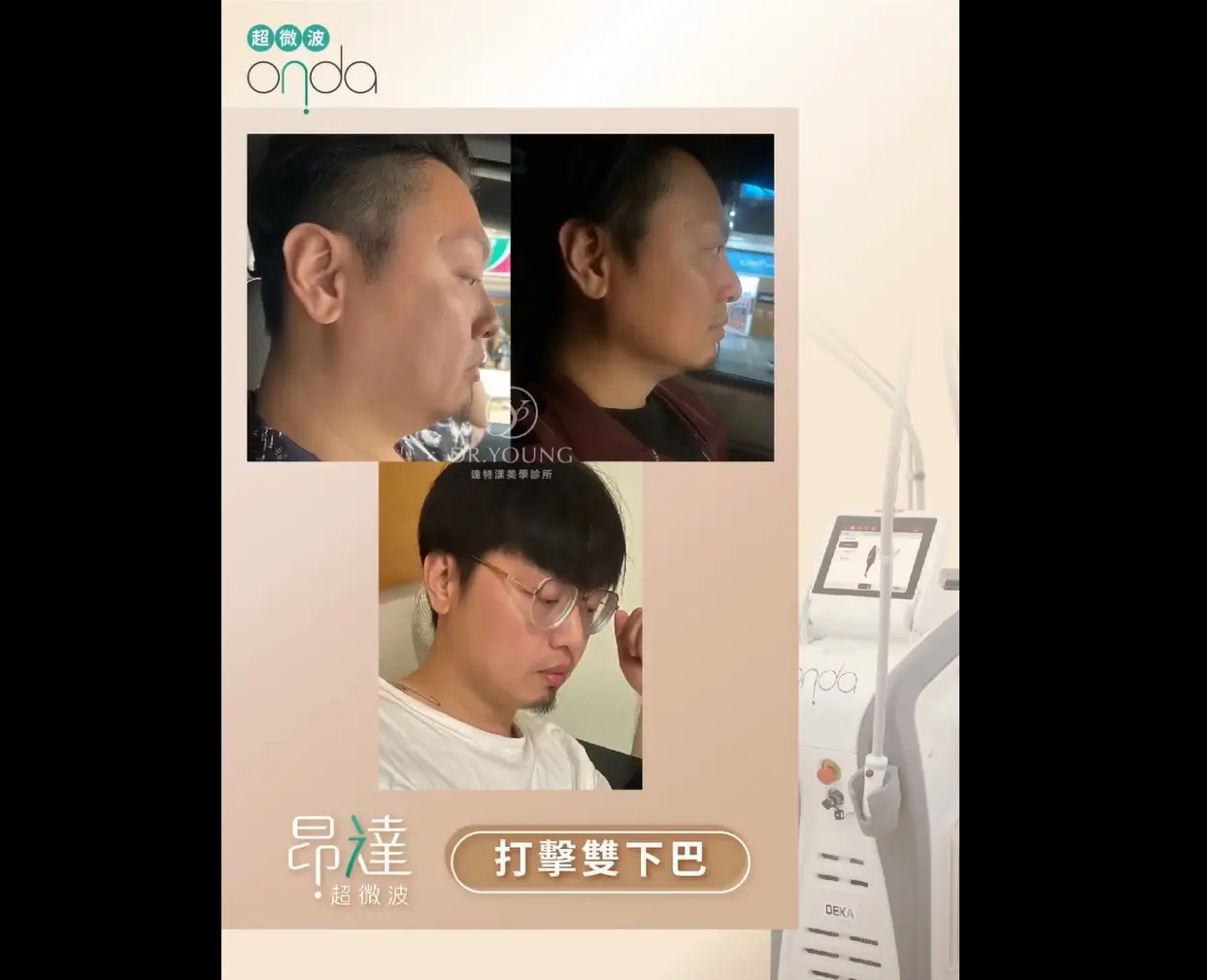 ONDA昂達超微波 代謝多餘脂肪 輪廓線雕塑設計 下顎線精修體驗正式啟動