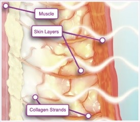 將熱能傳導至較深層且富含最多膠原蛋白的真皮層和皮下組織,高雄(俗稱)鳳凰電波thermage FLX